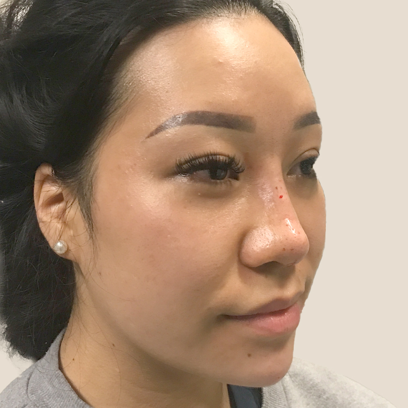 Non Surgical Rhinoplasty 03