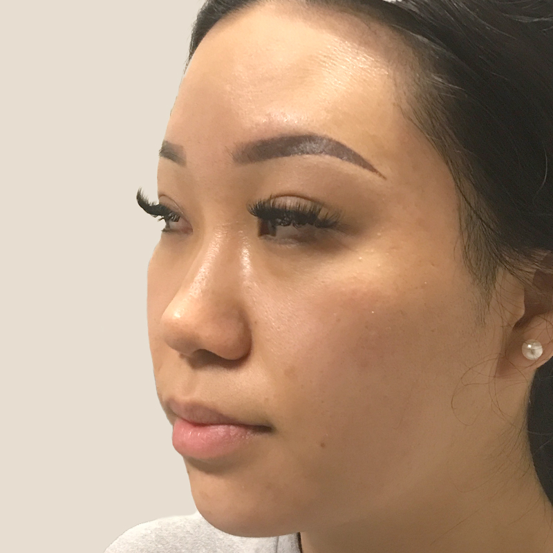 Non Surgical Rhinoplasty 07