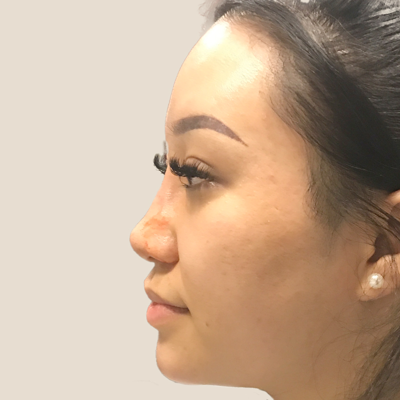 Non Surgical Rhinoplasty 09