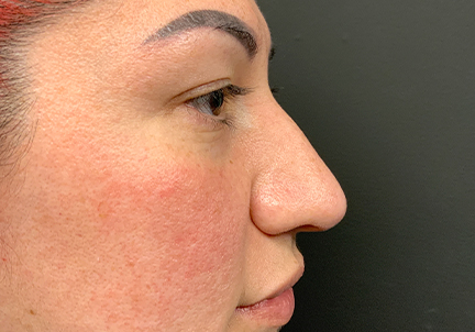 Non Surgical Rhinoplasty 01