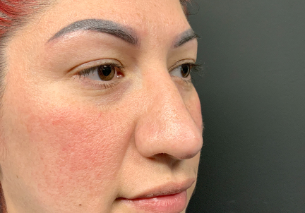 Non Surgical Rhinoplasty 03