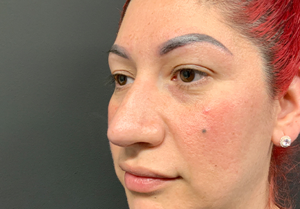 Non Surgical Rhinoplasty 05