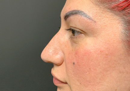 Non Surgical Rhinoplasty 07