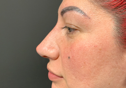 Non Surgical Rhinoplasty 07