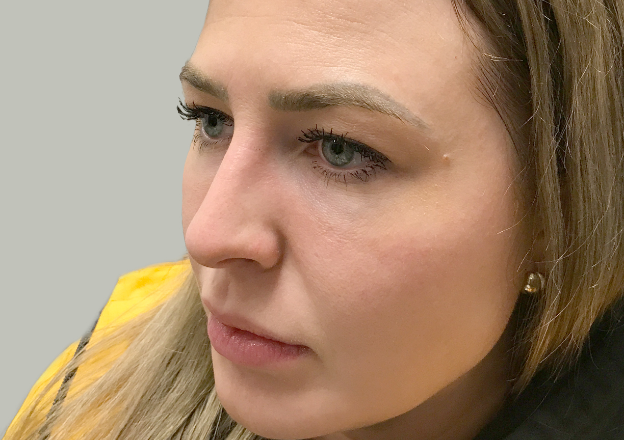 Non Surgical Rhinoplasty 01