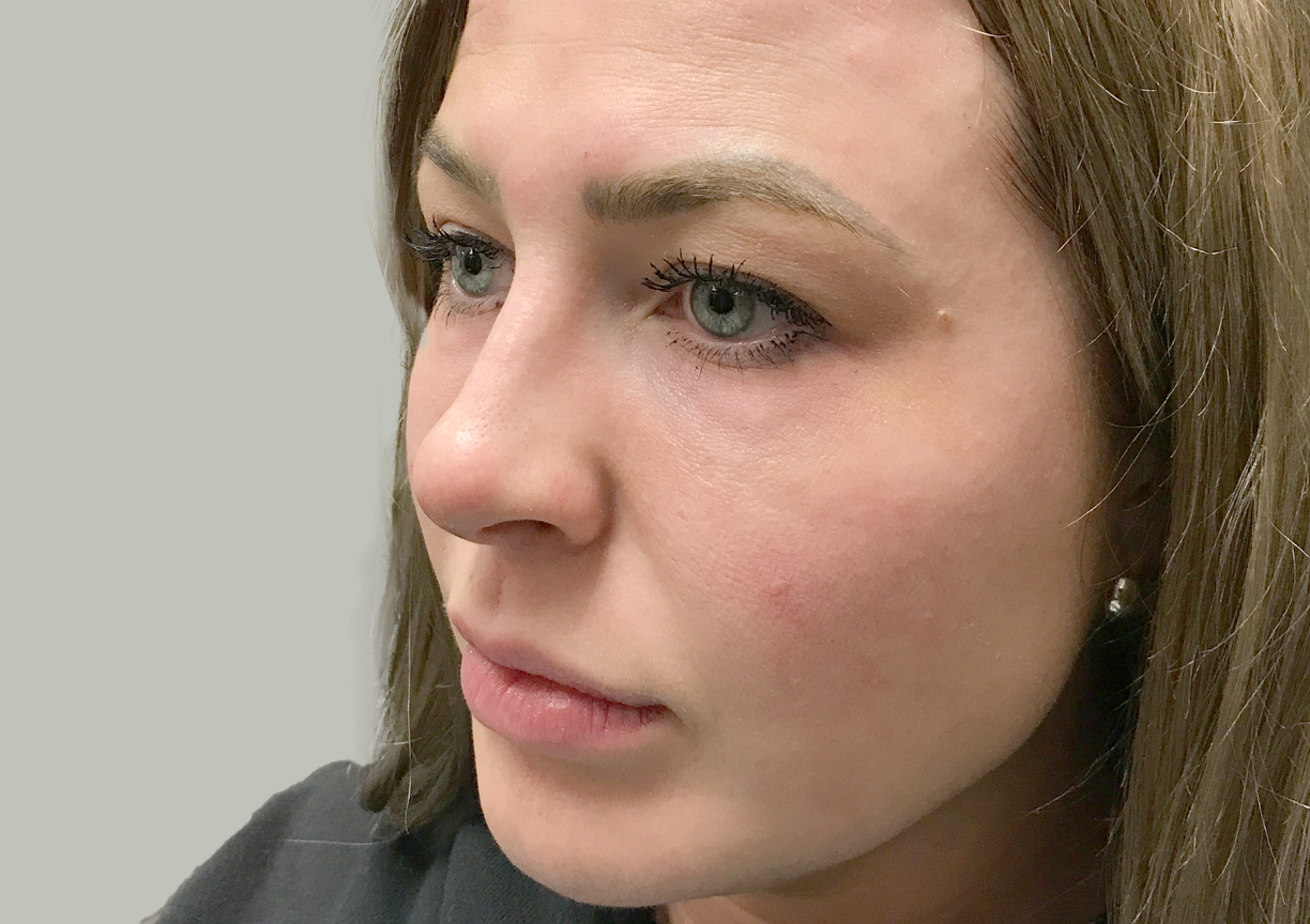 Non Surgical Rhinoplasty 04