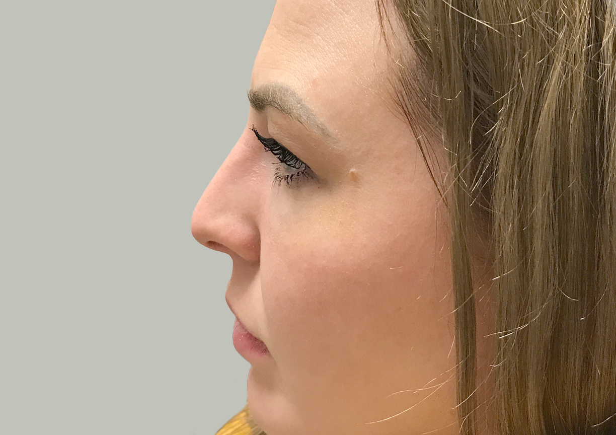 Non Surgical Rhinoplasty 03