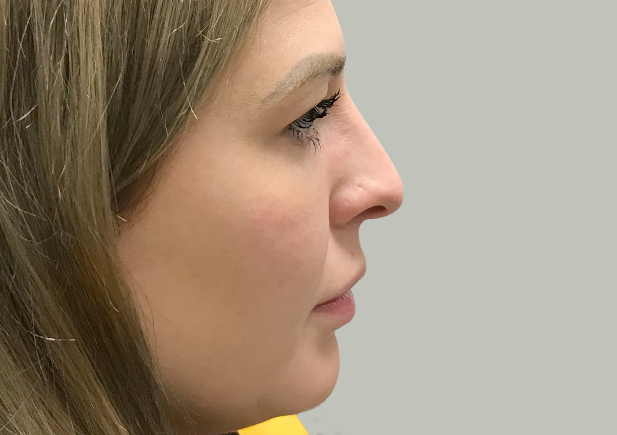 Non Surgical Rhinoplasty 05