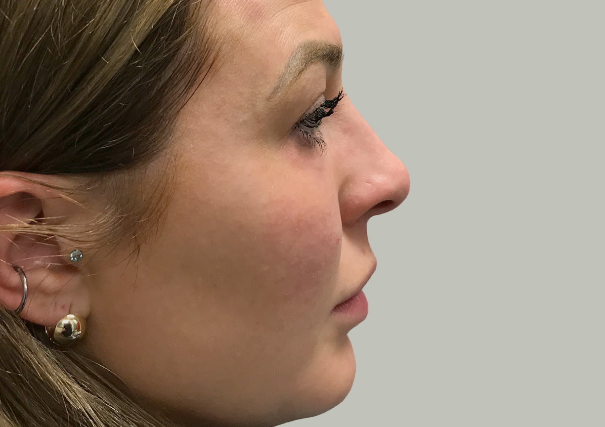 Non Surgical Rhinoplasty 05