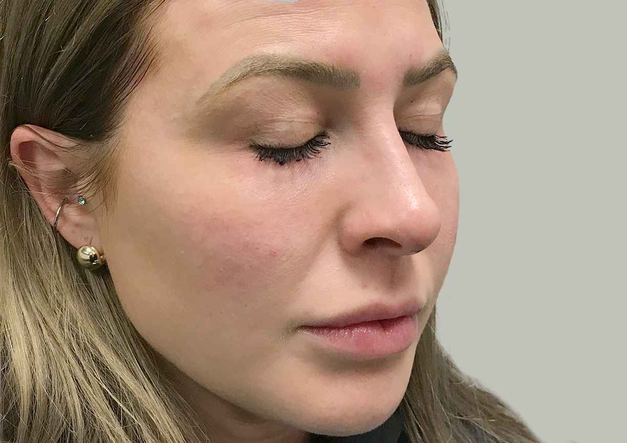 Non Surgical Rhinoplasty 07