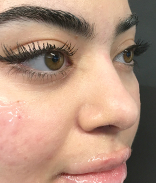 Non Surgical Rhinoplasty 01