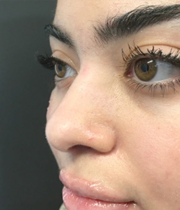 Non Surgical Rhinoplasty 05