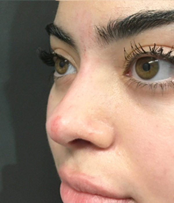Non Surgical Rhinoplasty 05
