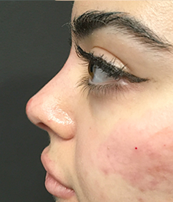 Non Surgical Rhinoplasty 07