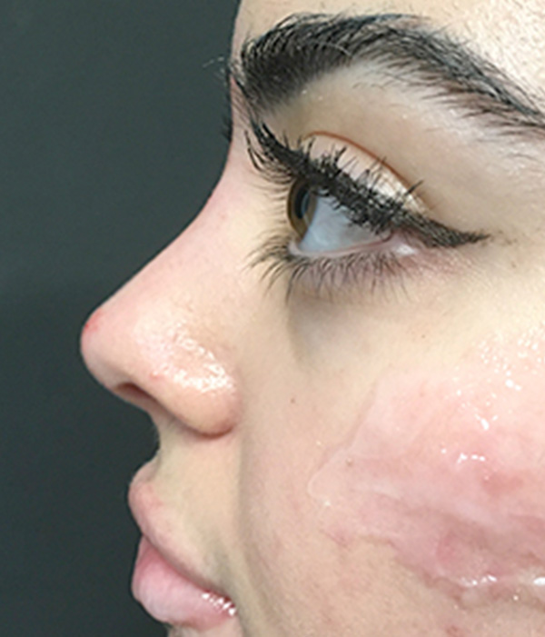 Non Surgical Rhinoplasty 07