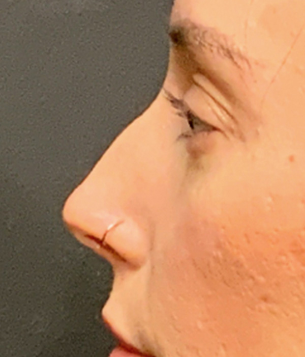 Non Surgical Rhinoplasty 03