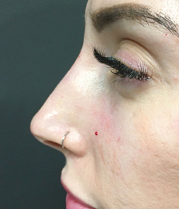 Non Surgical Rhinoplasty 03