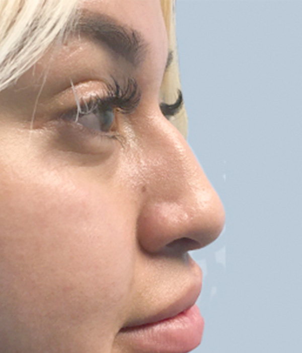 Non Surgical Rhinoplasty 01