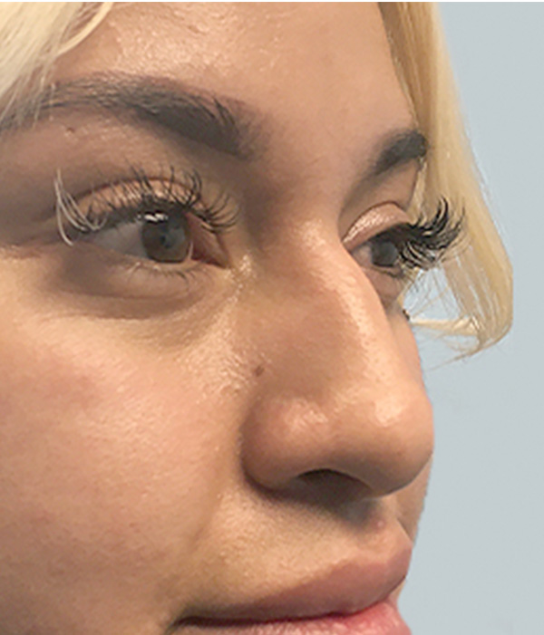 Non Surgical Rhinoplasty 03