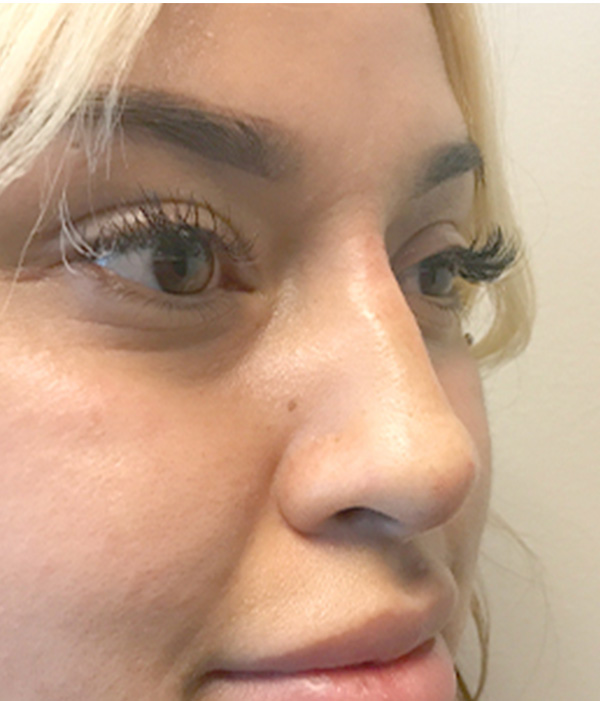 Non Surgical Rhinoplasty 03
