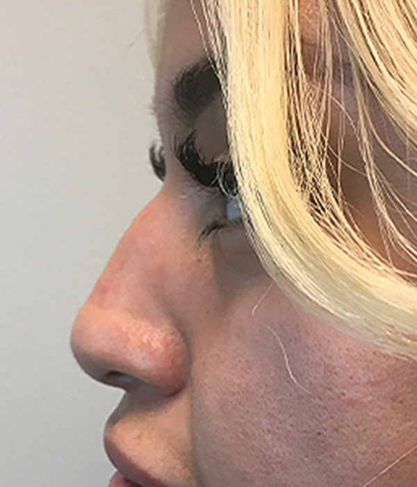 Non Surgical Rhinoplasty 05