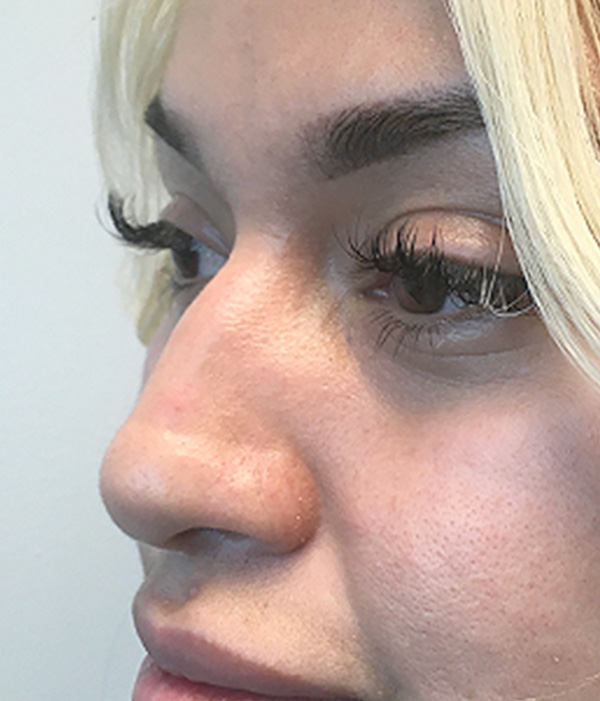 Non Surgical Rhinoplasty 07