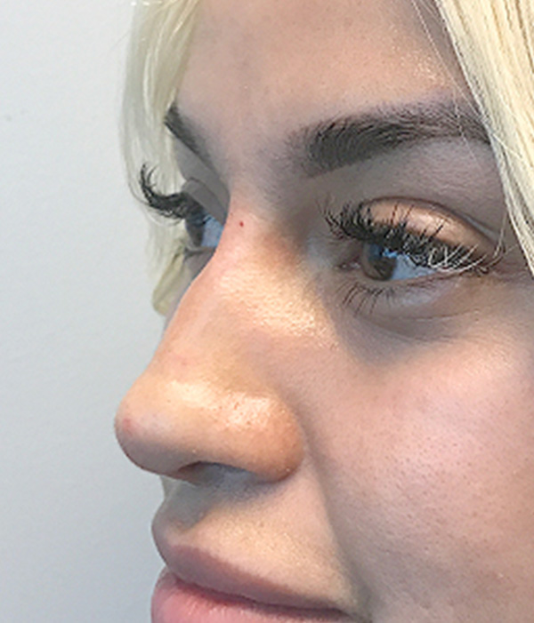 Non Surgical Rhinoplasty 07