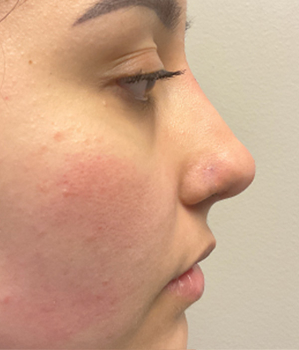 Non Surgical Rhinoplasty 08