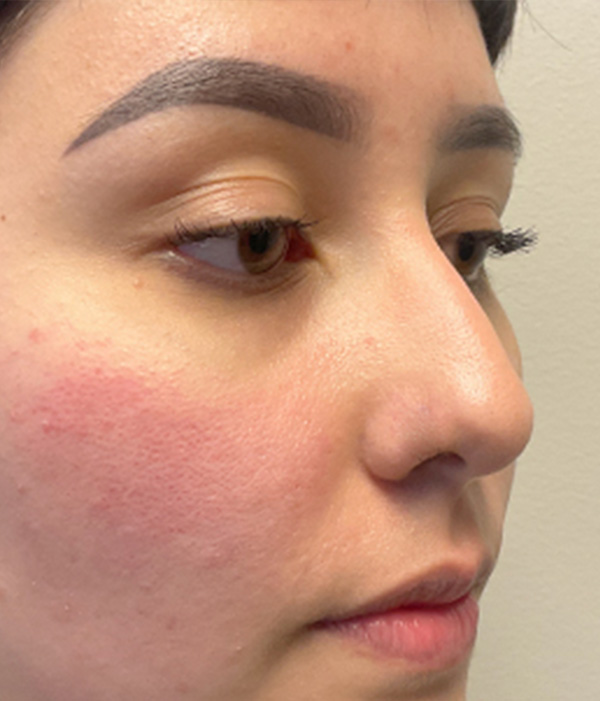 Non Surgical Rhinoplasty 03