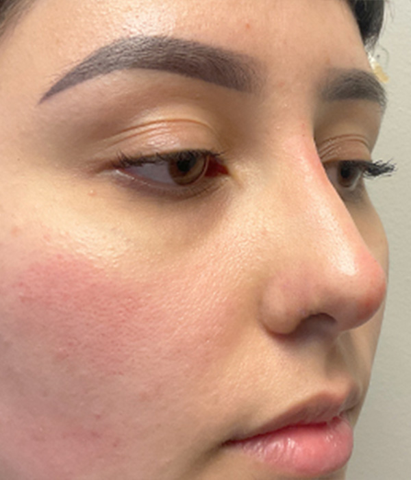 Non Surgical Rhinoplasty 03