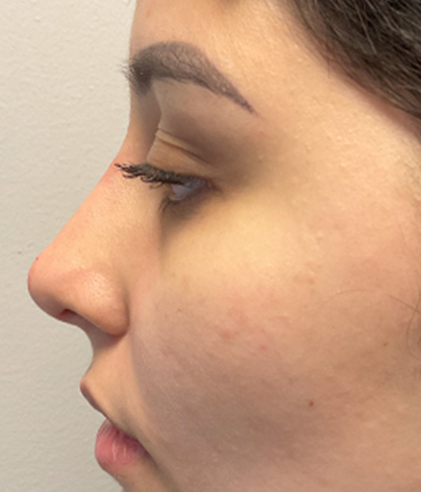 Non Surgical Rhinoplasty 07