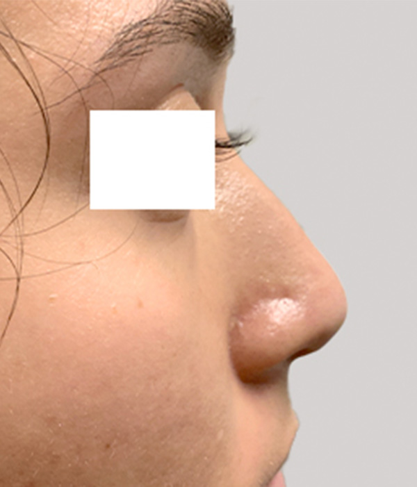 Non Surgical Rhinoplasty 01