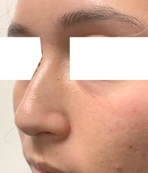 Non Surgical Rhinoplasty 07