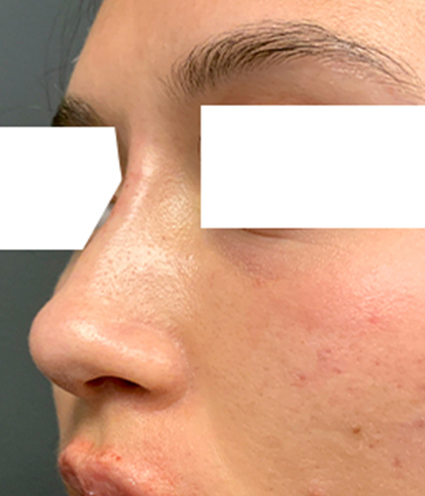Non Surgical Rhinoplasty 07