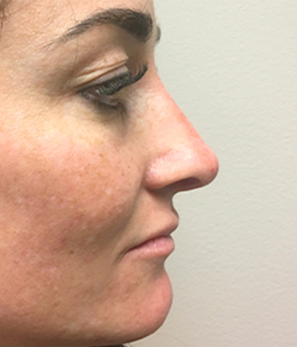 Non Surgical Rhinoplasty 10