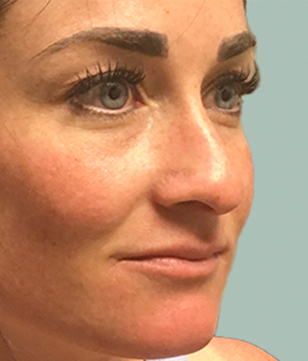 Non Surgical Rhinoplasty 03