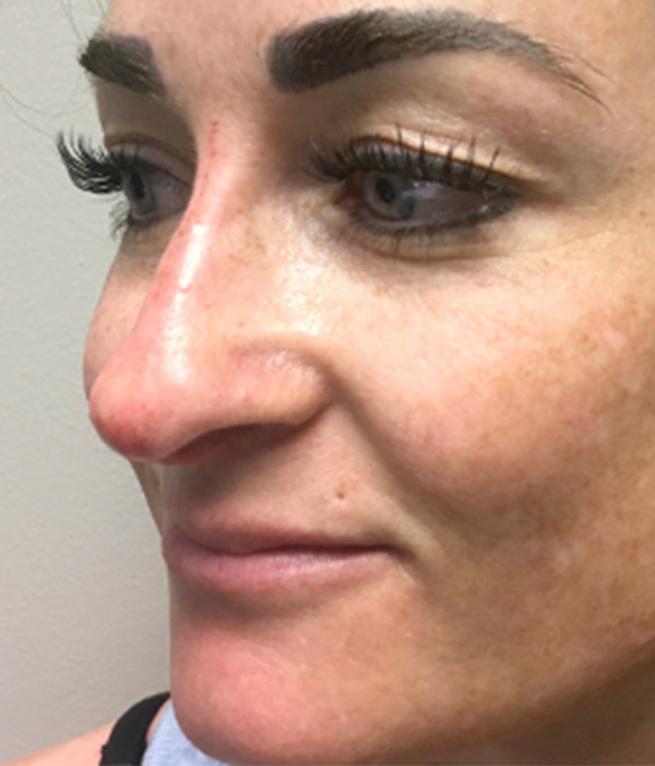 Non Surgical Rhinoplasty 05