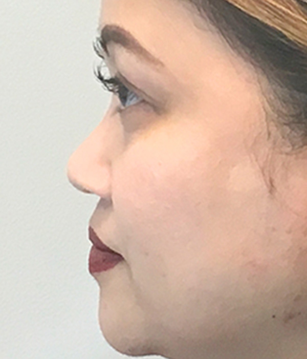 Non Surgical Rhinoplasty 01