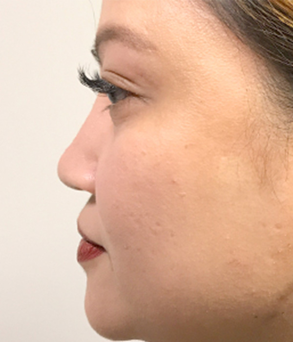 Non Surgical Rhinoplasty 11