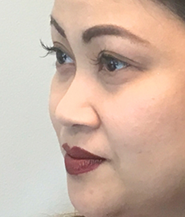 Non Surgical Rhinoplasty 03