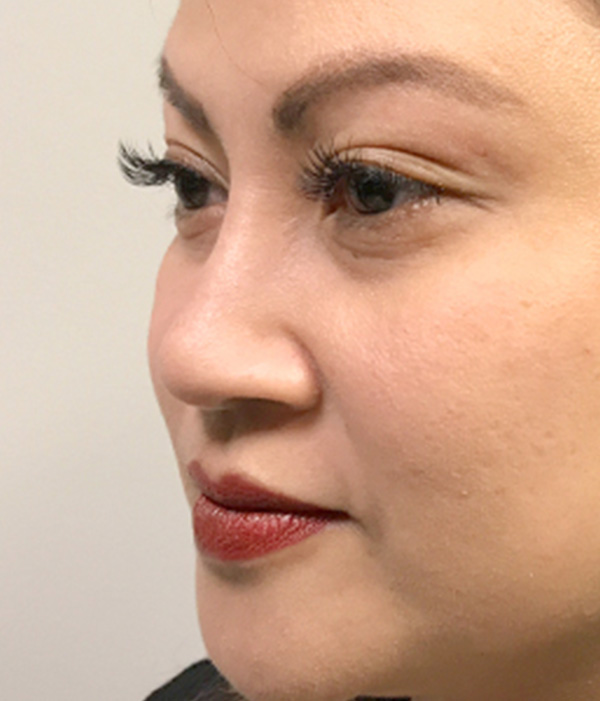 Non Surgical Rhinoplasty 03