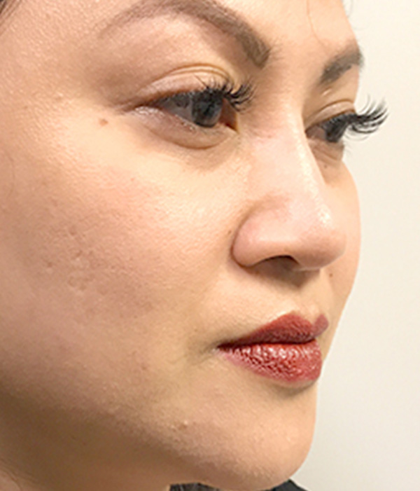 Non Surgical Rhinoplasty 05