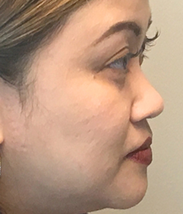 Non Surgical Rhinoplasty 07