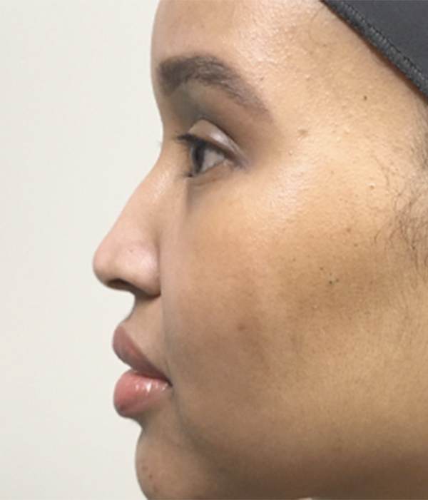 Non Surgical Rhinoplasty 01