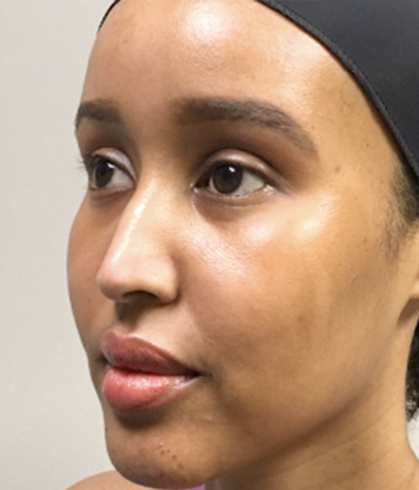 Non Surgical Rhinoplasty 03