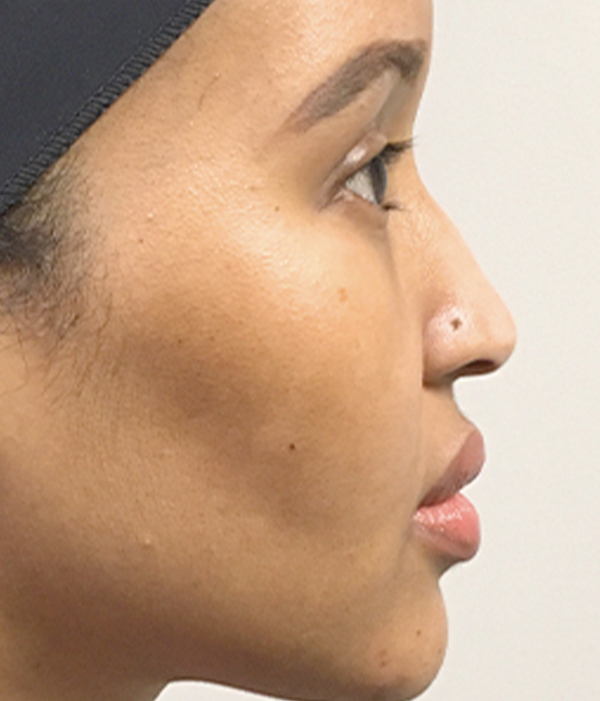 Non Surgical Rhinoplasty 05