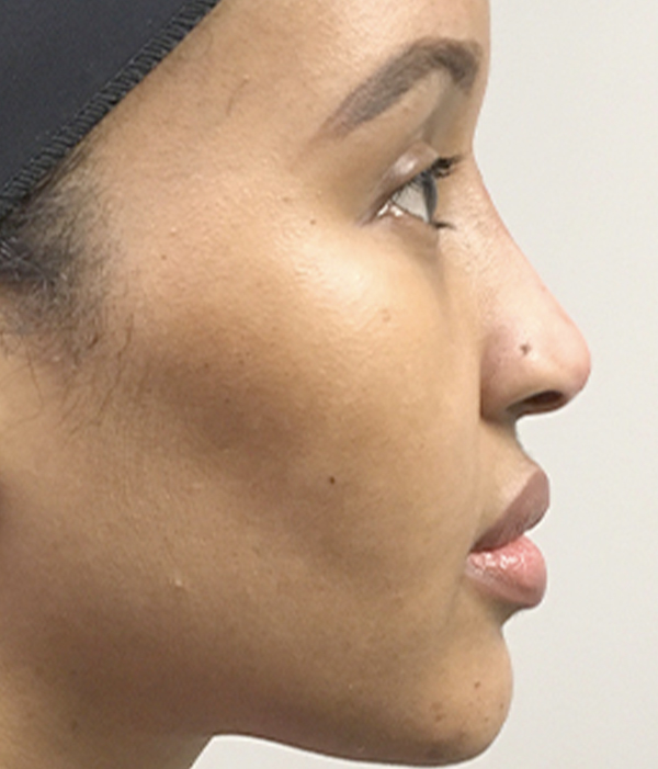 Non Surgical Rhinoplasty 05