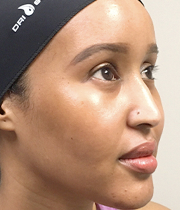 Non Surgical Rhinoplasty 07