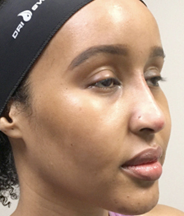 Non Surgical Rhinoplasty 07