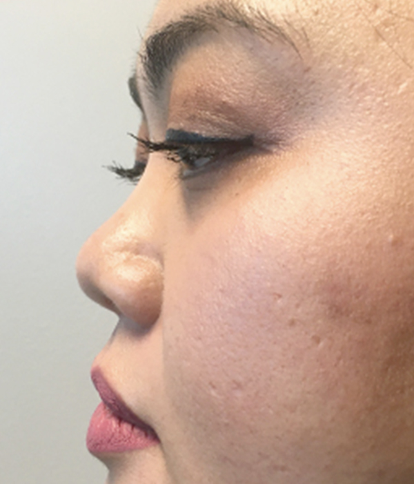 Non Surgical Rhinoplasty 01